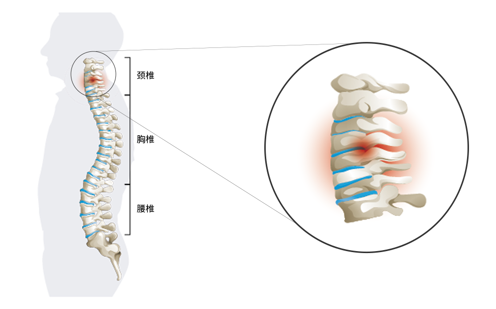 脊椎的结构。颈椎间盘退化